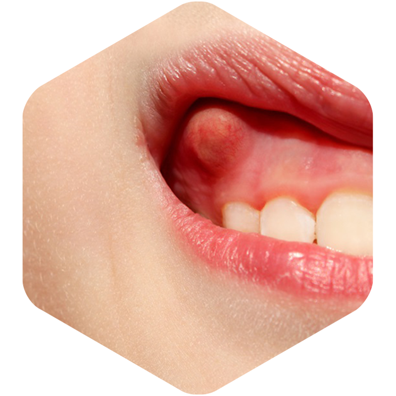 Teenager with inflamed gums